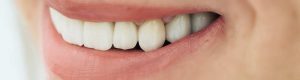 Zirconia Smile Dental Masters Dental Lab